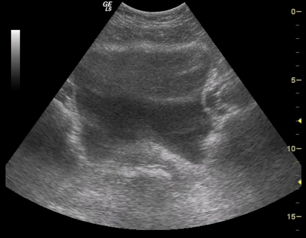 your bladder and innovo in action