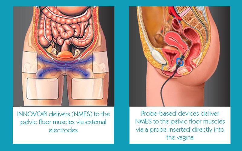 how innovo helps your pelvic floor
